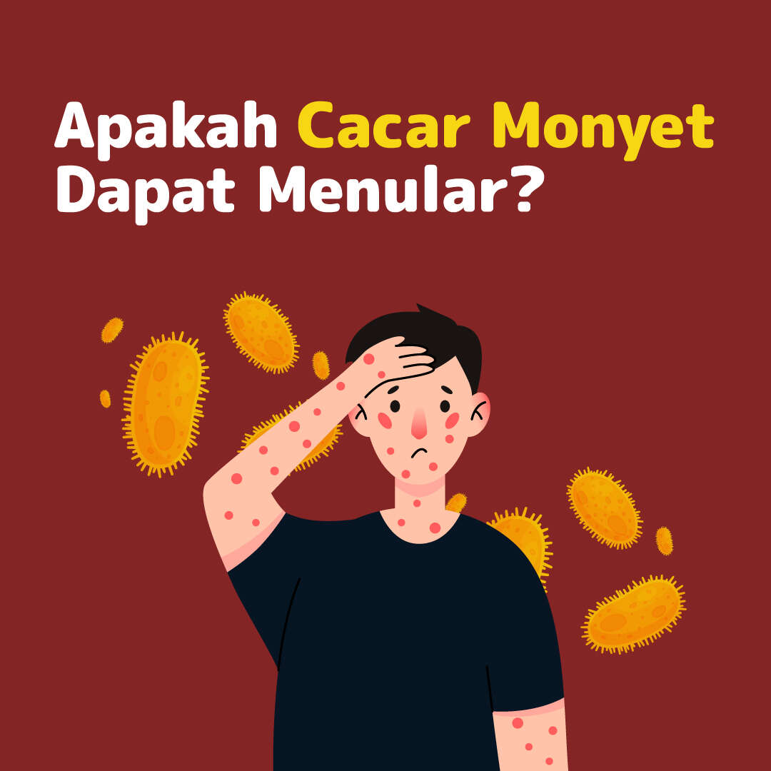 Apakah Cacar Monyet Dapat Menular?